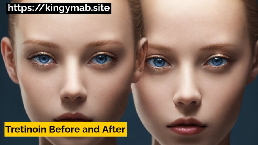 tretinoin before and after 